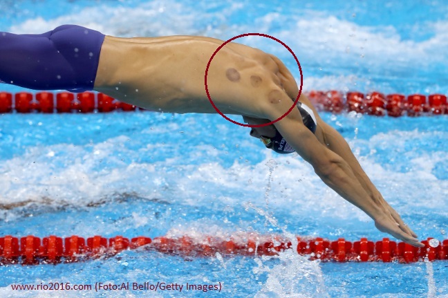 Michael Phelps Ventosaterapia Cupping therapy Feeldeporte Rio2016